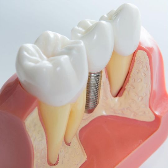 implantación de dientes