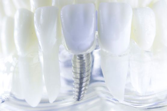 implantología dental